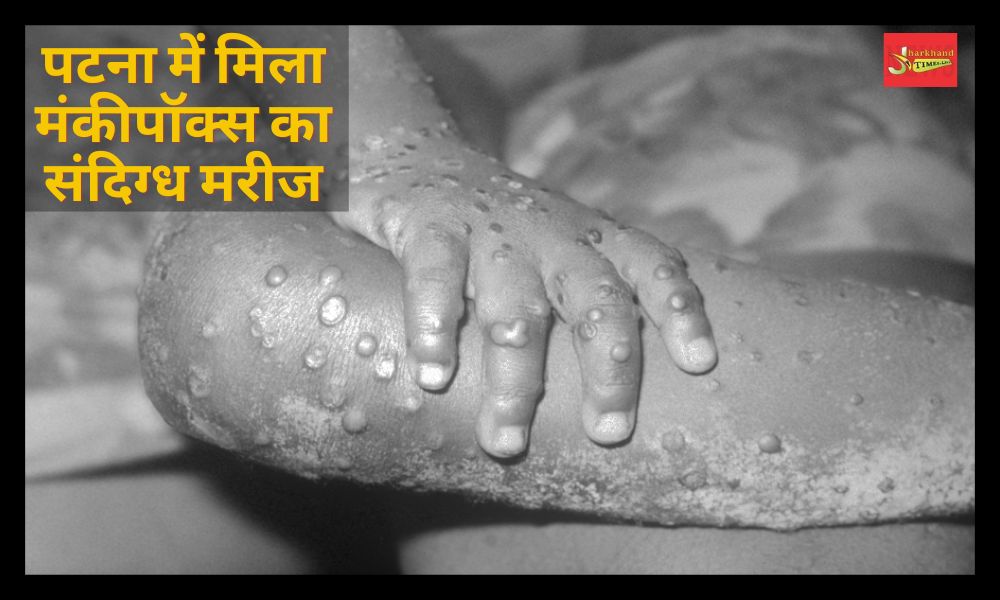 Suspected patient of monkeypox found in Patna