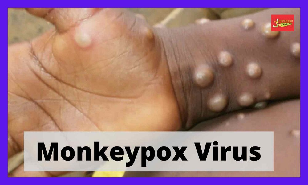 Country's first monkeypox patient recovered